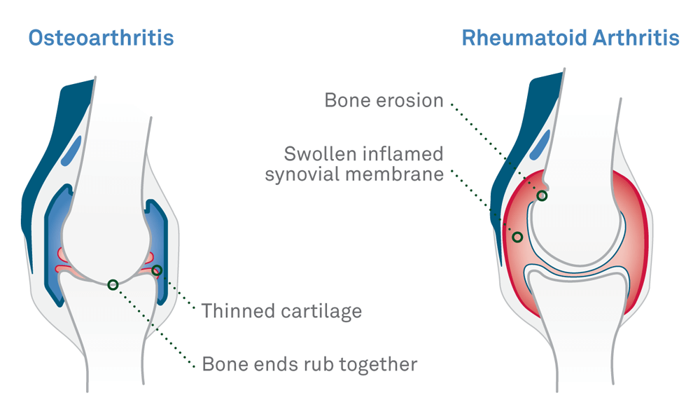 Drawings of joints show differences between osteoarthritis on the left, with thinned cartilage and bone ends rubbing together, versus rheumatoid arthritis on the right, with bone erosion and swollen inflamed synovial membrane.